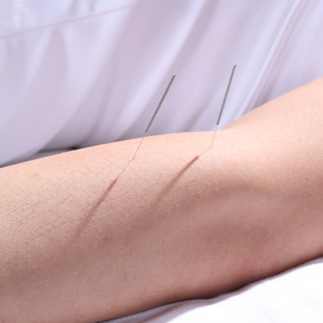 100 Pcs Stainless Steel Wire Handle Acupuncture Needles With Aluminum Foil Packing